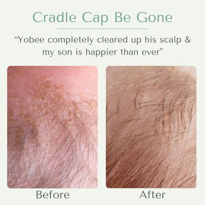 Yobee Ultra Gentle Scalp Mask – Probiotic Dry Scalp Care for Babies (4 oz)