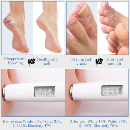 YOUNGYOUNGLOVE 70% Urea Cream with 2% Salicylic Acid – 10.1 oz