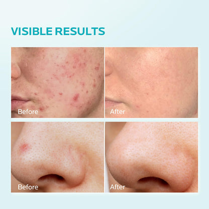 ZealSea 10% Azelaic Acid Facial Cream with AHA & Pionin - Gentle, Barrier-Supporting Formula