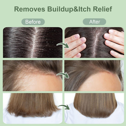 ZENGYQI Scalp Scrub Rosemary & Mint with Biotin | Exfoliating Massager for Itchy Scalp